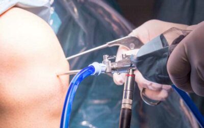 Arthroscopic Rotator Cuff Repair – Video