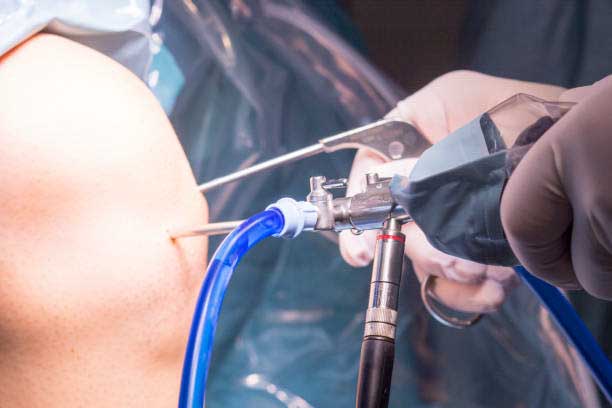 Arthroscopic Rotator Cuff Repair – Video